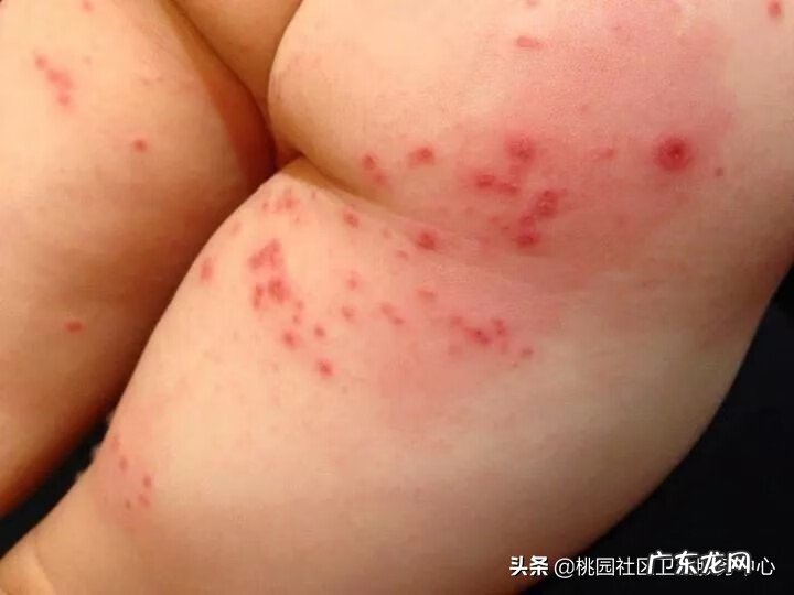 手足口开始好的征兆 手足口病