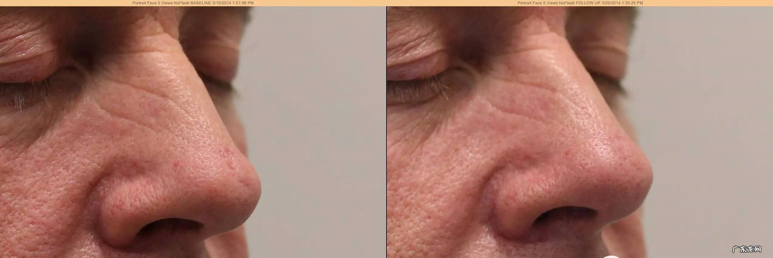 脸上一脸痘坑怎么办 脸上有痘坑怎么治疗