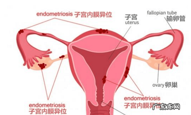 子宫异位症严重了什么症状 子宫异位症是什么