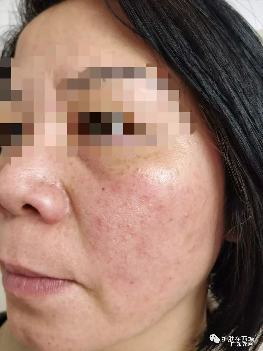 面部皮炎和激素脸的区别 面部激素性皮炎图片