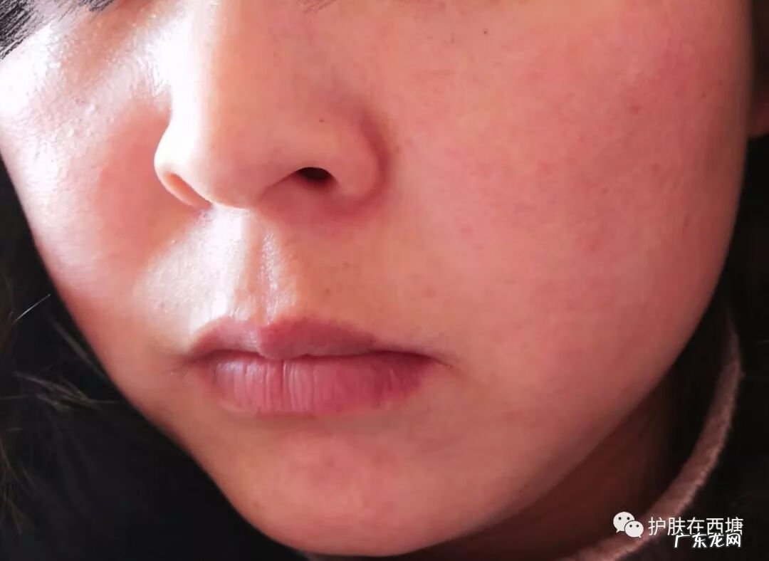面部皮炎和激素脸的区别 面部激素性皮炎图片