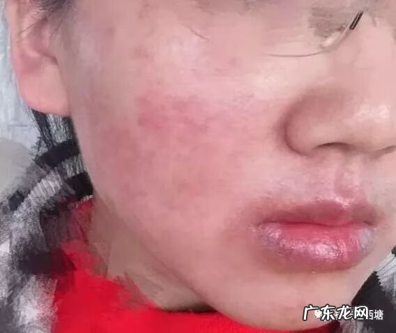 面部皮炎和激素脸的区别 面部激素性皮炎图片