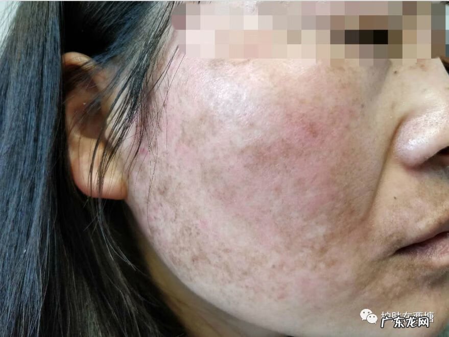 面部皮炎和激素脸的区别 面部激素性皮炎图片
