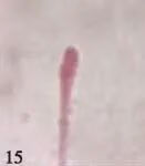 畸形精子症能生育吗 畸形精子症