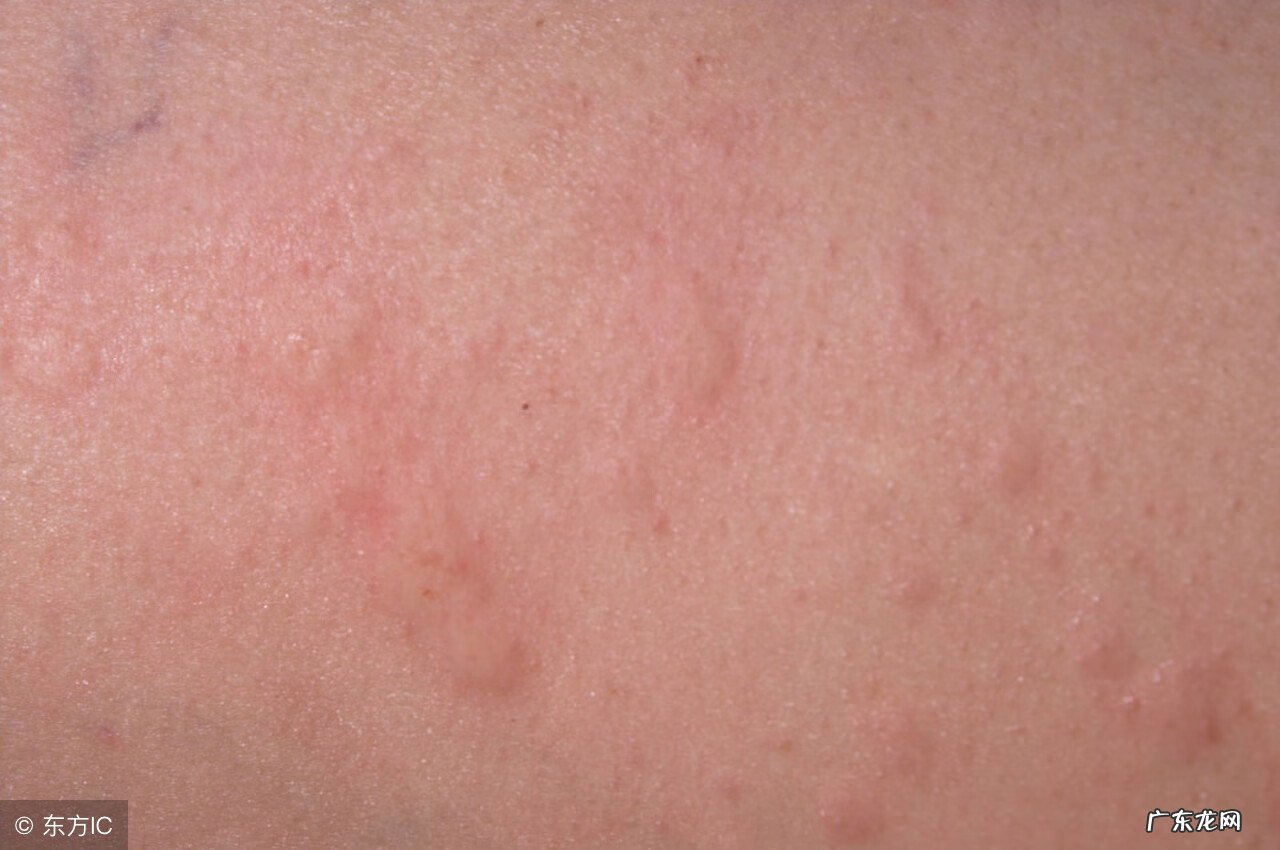 慢性荨麻疹会不会遗传 慢性荨麻疹遗传么