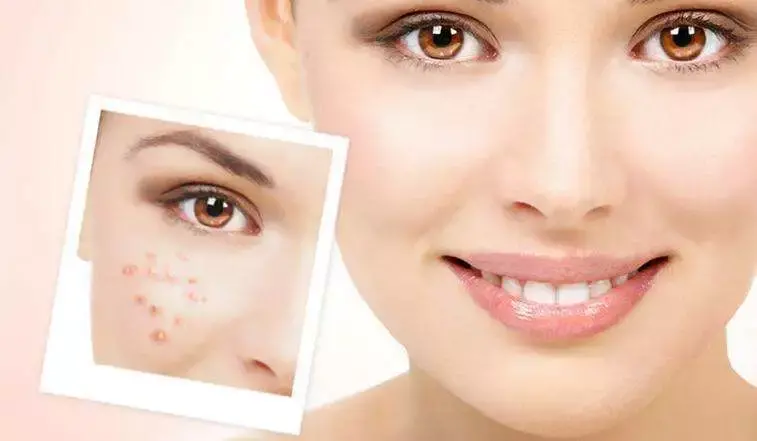 去痘痘的有效方法 怎么去痘痘的方法