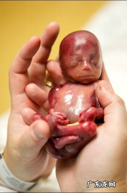 19周早产儿图片欣赏 19周早产儿