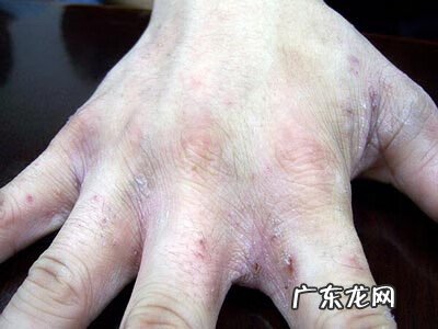 鹅掌花图片 鹅掌风图片