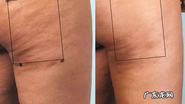 为什么会有橘皮组织 橘皮组织是怎么形成的