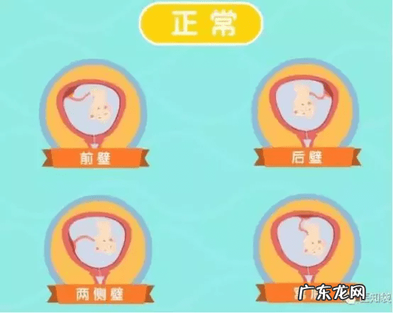 胎位ROA是什么位置 产检胎位roa是什么意思