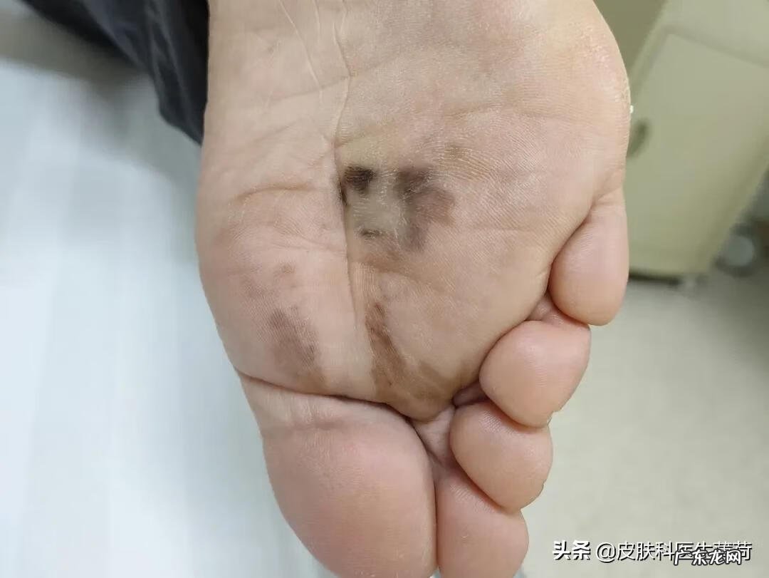 祛痣风水 风水祛痣可信吗