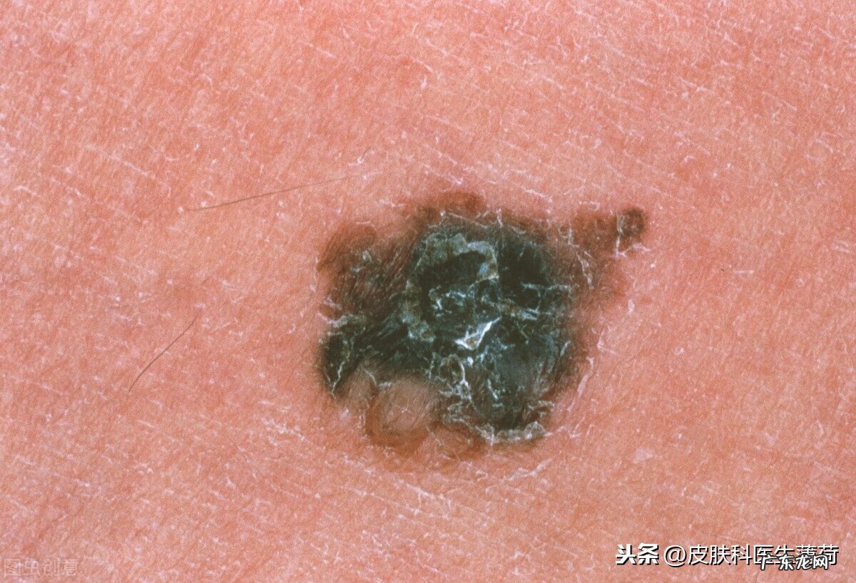 祛痣风水 风水祛痣可信吗