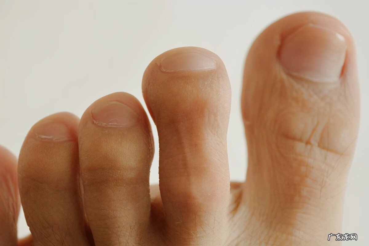 脚趾甲沟炎如何自己处理 脚趾甲沟炎怎么办?