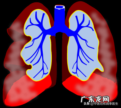 一人得肺结核全家传染 肺结核传染病吗