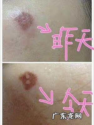 扁平疣都不能吃什么