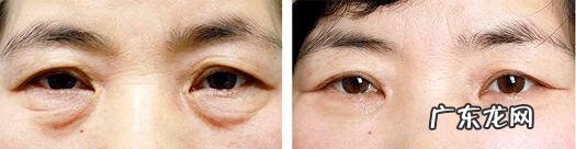 快速消除眼袋的小窍门 怎么样除去眼袋