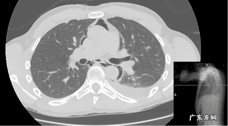 胸前疼痛是怎么回事 运动后胸部痛怎么回事
