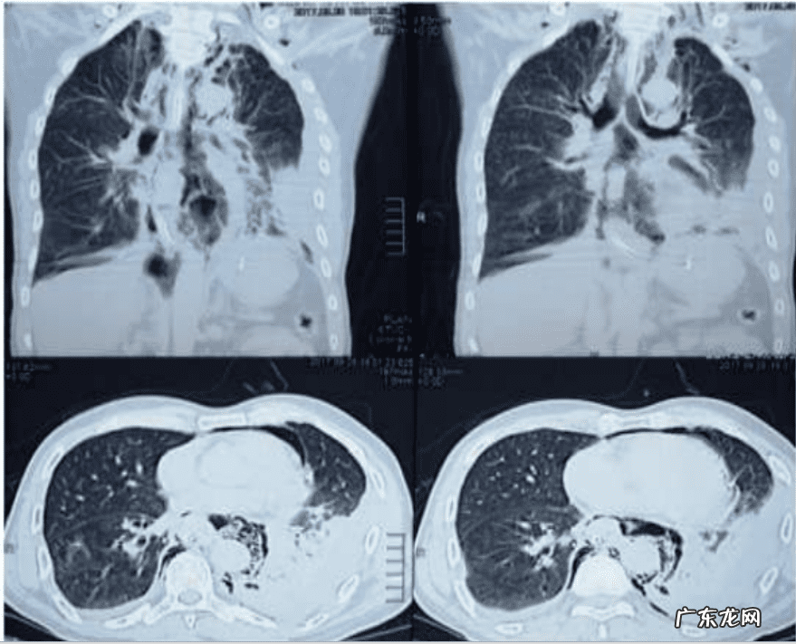 胸前疼痛是怎么回事 运动后胸部痛怎么回事