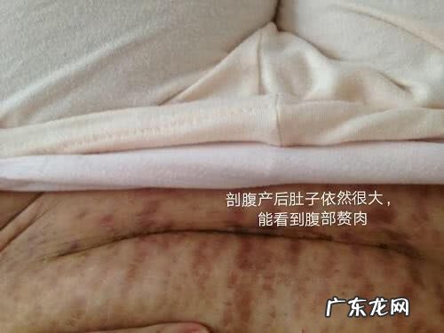 剖腹产恶露颜色的变化图片 剖腹产后恶露一直不干净是什么原因