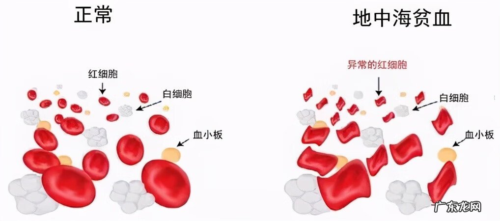 地中海贫血是什么意思