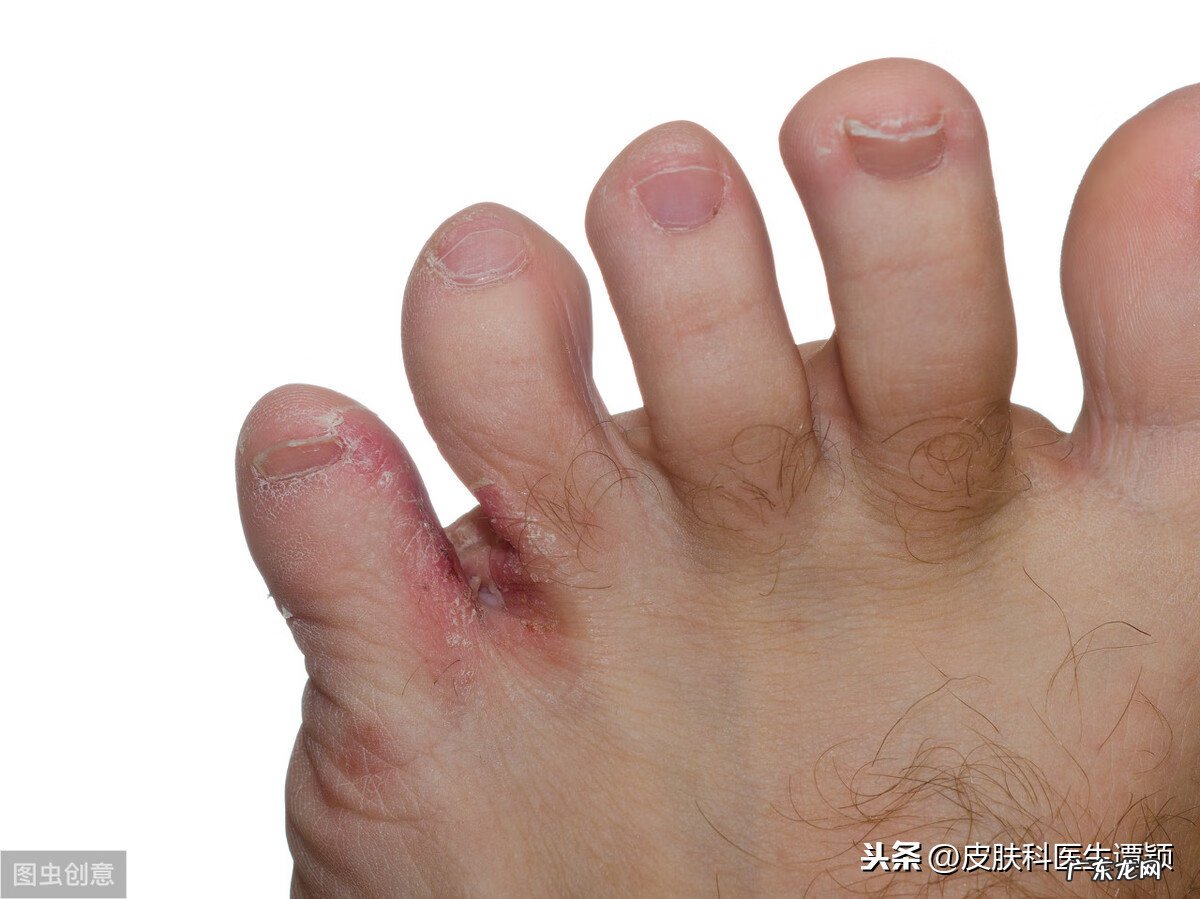 脚丫子烂了怎么办 脚丫烂了怎么办