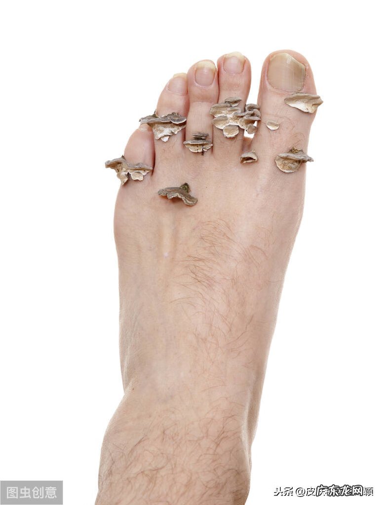 脚丫子烂了怎么办 脚丫烂了怎么办
