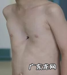漏斗胸的最佳手术年龄 先天性漏斗胸是什么引起的