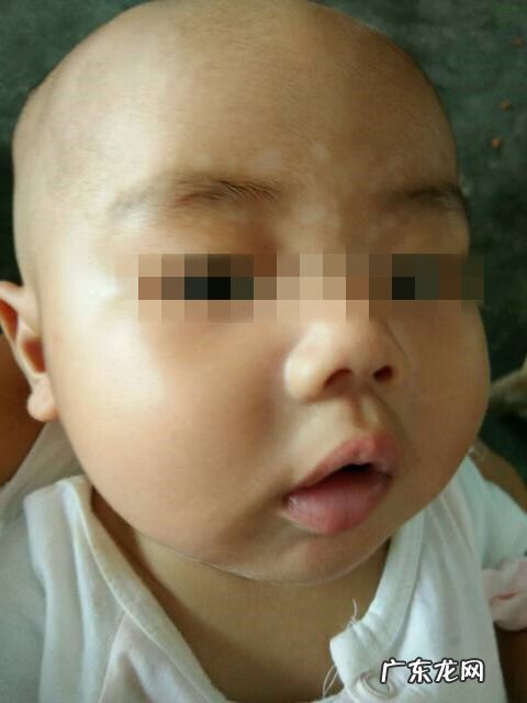 身上白块是什么 身上白块是什么原因