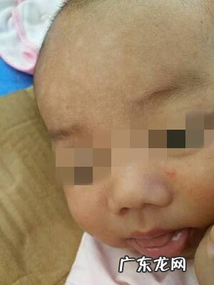 身上白块是什么 身上白块是什么原因