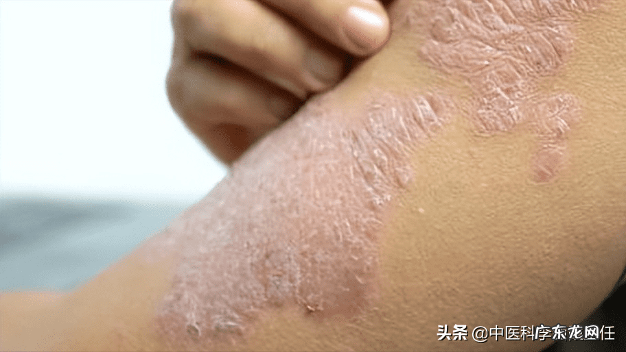 牛皮肤癣早期症状 牛皮肤癣的症状图片