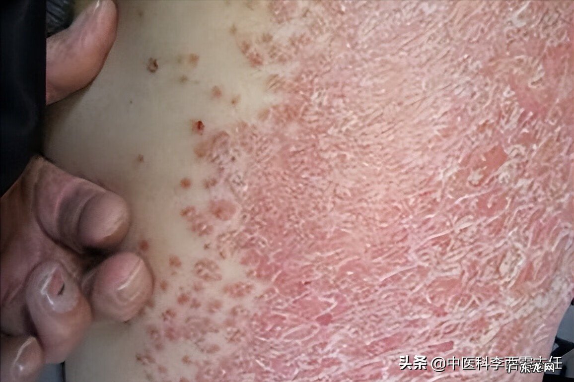 牛皮肤癣早期症状 牛皮肤癣的症状图片