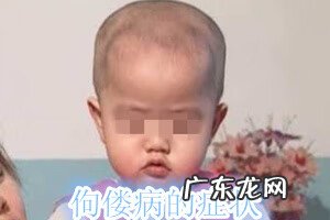 佝偻病的症状是什么 佝偻病有哪些症状,怎样治疗