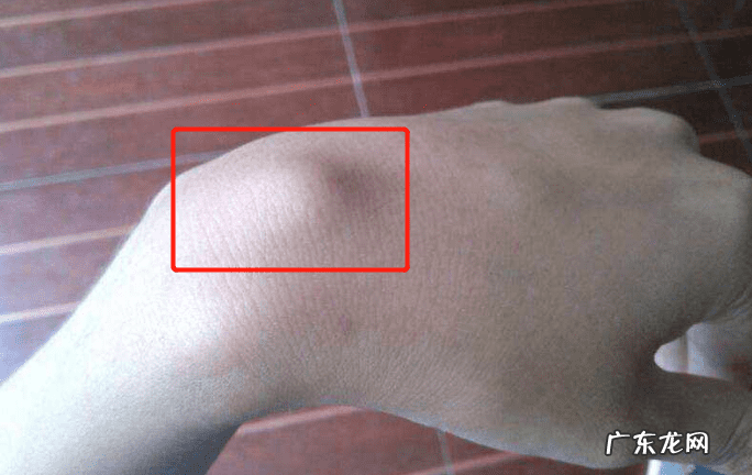 手关节痛怎么治 最近手关节痛是怎么回事