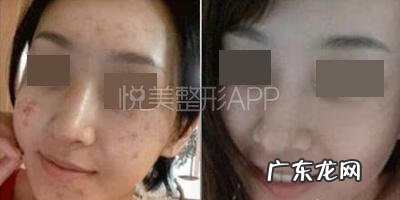 脸上青春痘快速去除 青春痘怎么去掉啊
