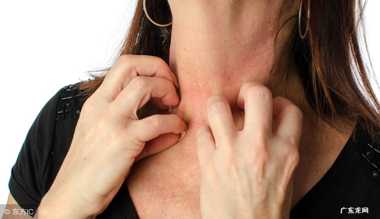 过敏性皮炎如何缓解 过敏性皮炎该怎么治疗