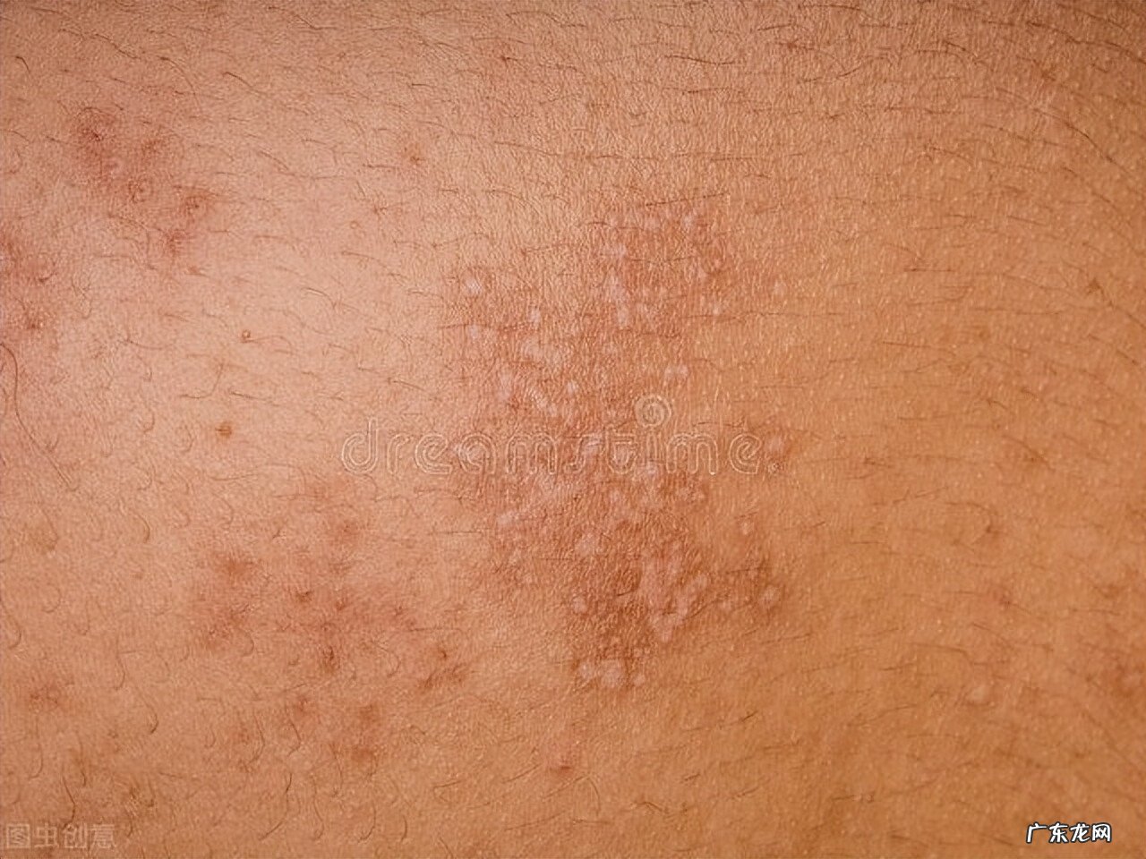 病毒性疱疹有没有传染性 病毒性疱疹传染吗?