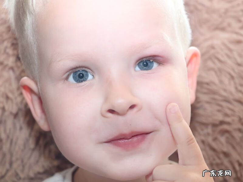 红眼病怎么治 怎样治疗红眼病?