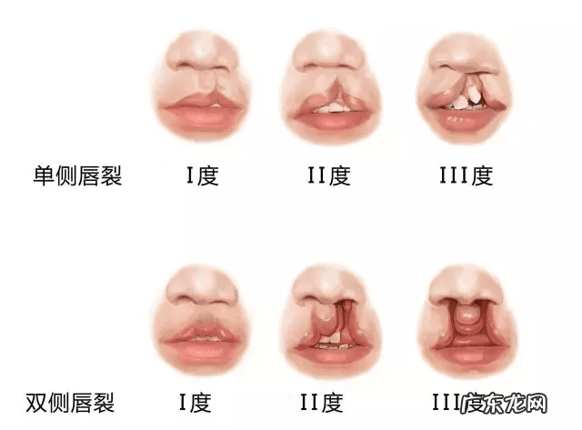 北京嫣然做唇腭裂费用 成人兔唇整形需要多少钱