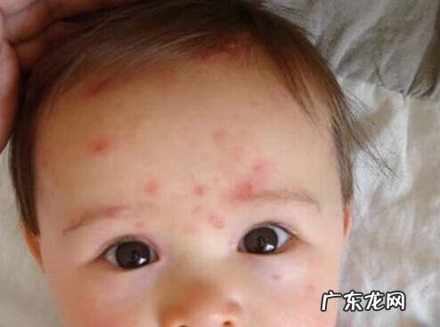 幼儿急疹最简单判断方法 幼儿急诊是什么状况