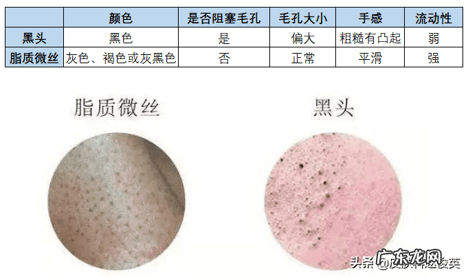 鼻子上长了个灰色的东西 鼻子上灰色