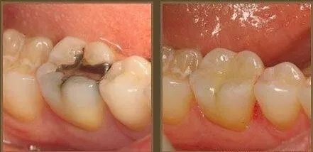 大牙有蛀牙掉了一半