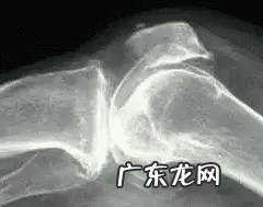 骨刺怎么治疗最好 骨刺的最好治疗方法是什么