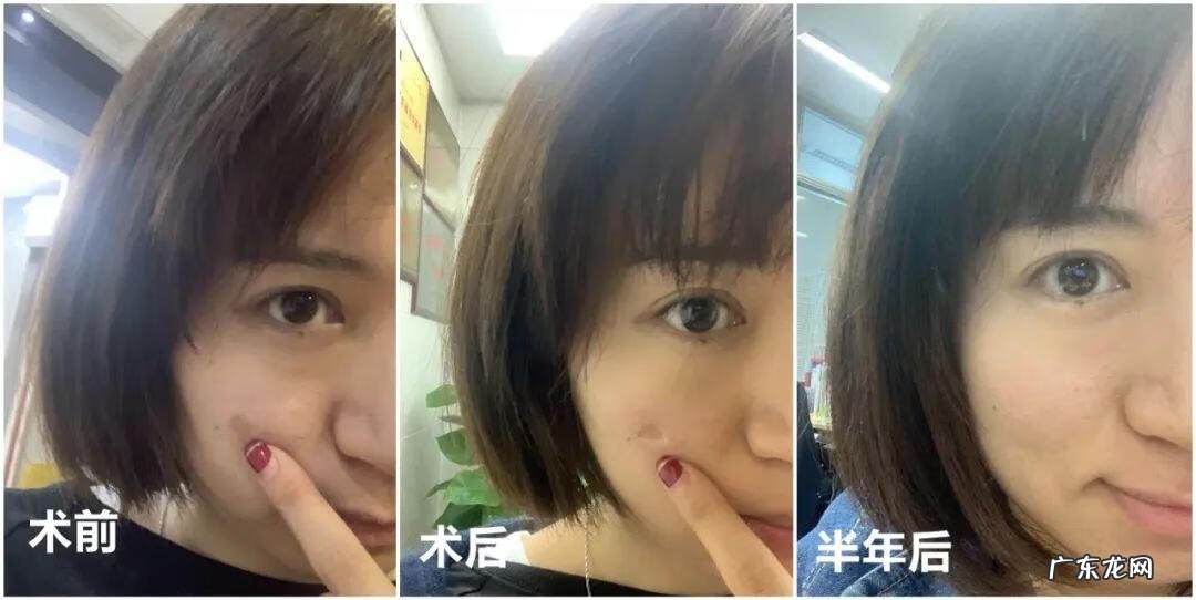 不整容脸怎么变小 改脸型修复