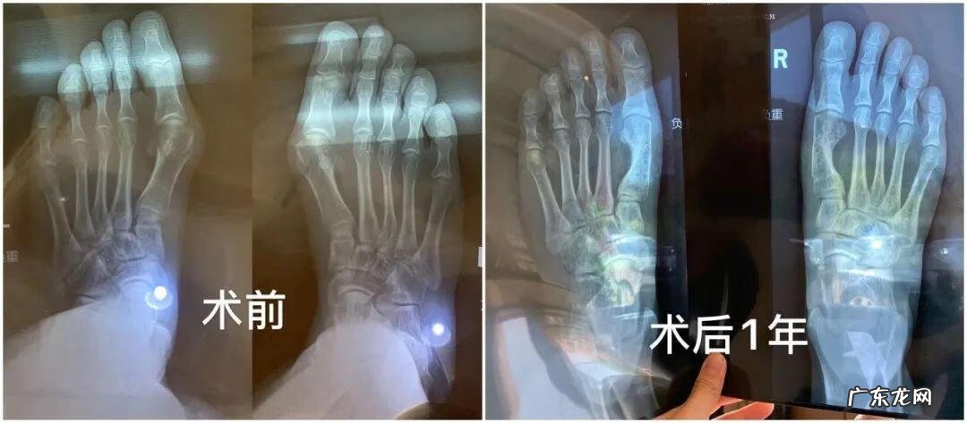 不整容脸怎么变小 改脸型修复