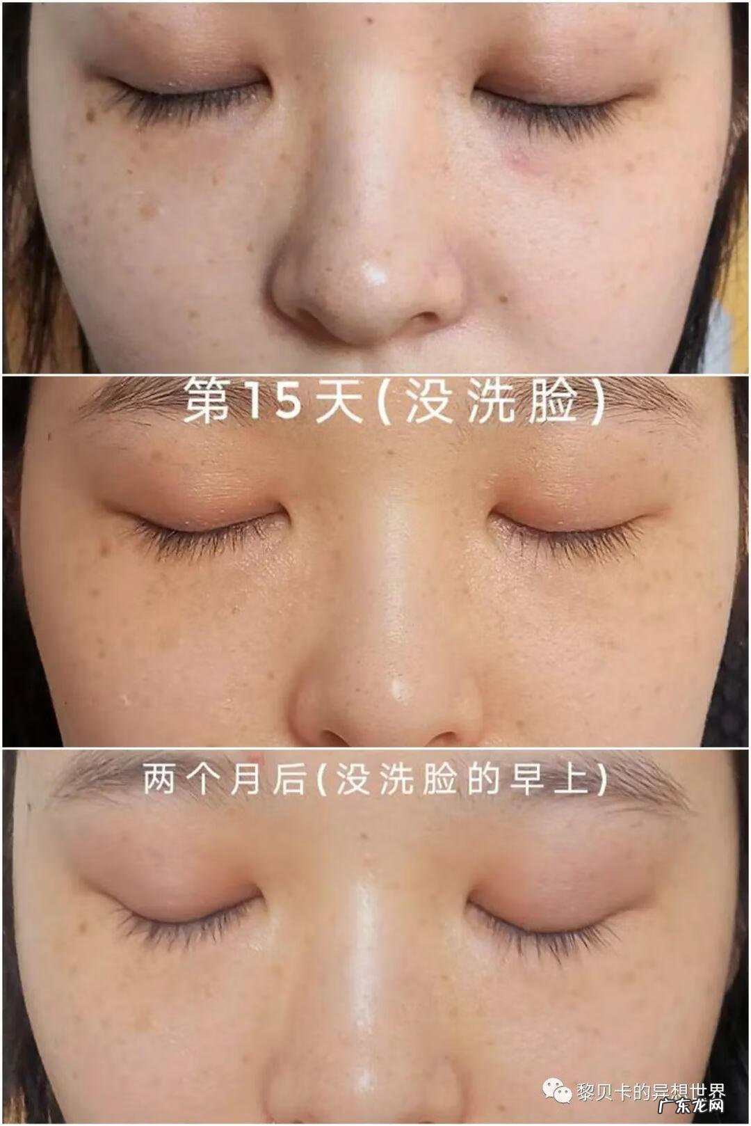 不整容脸怎么变小 改脸型修复