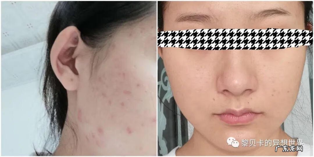 不整容脸怎么变小 改脸型修复