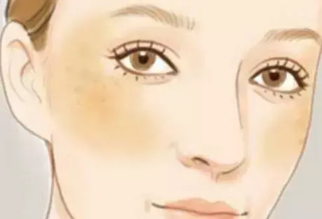 如何祛斑 怎样祛斑呢