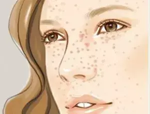 如何祛斑 怎样祛斑呢