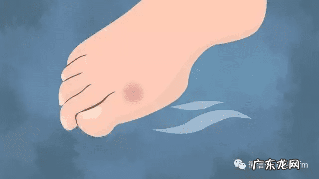 脚上起小水泡图片 脚上起小水泡是怎么回事