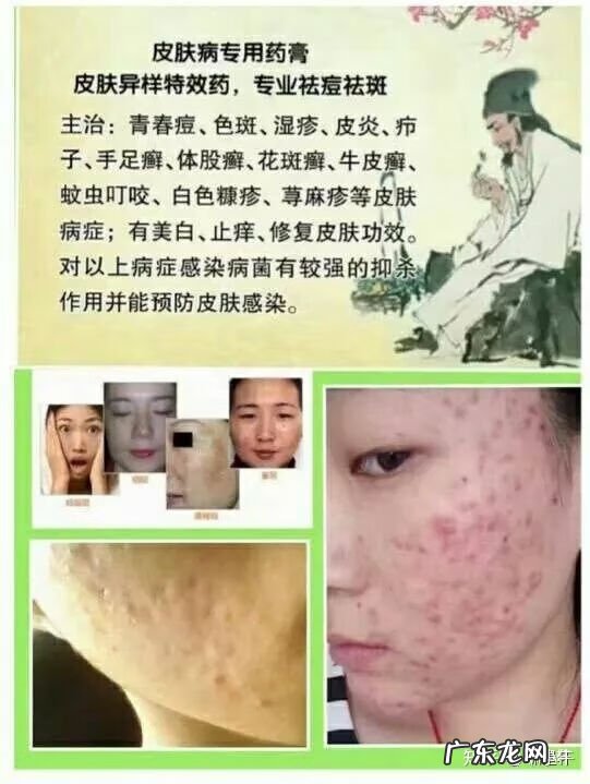 怎样有效地去除脸上的痘痘 脸上的痘痘怎么去除最有效